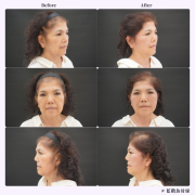 藍鑽魚骨線操作後示意圖